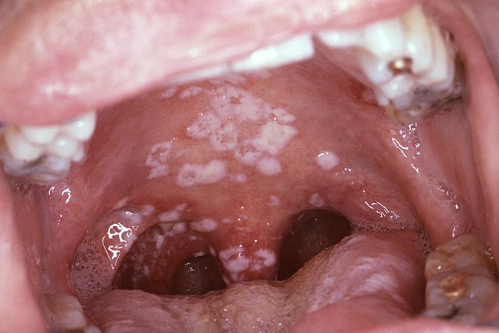 HIV opary v ústach 