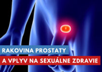 rakovina prostaty a sexuálny život