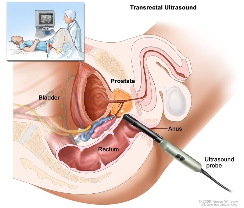 transrektálna sonografia prostaty