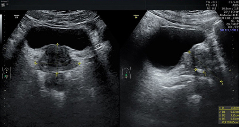 ultrazvuková sonografia prostaty