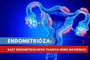 endometrióza